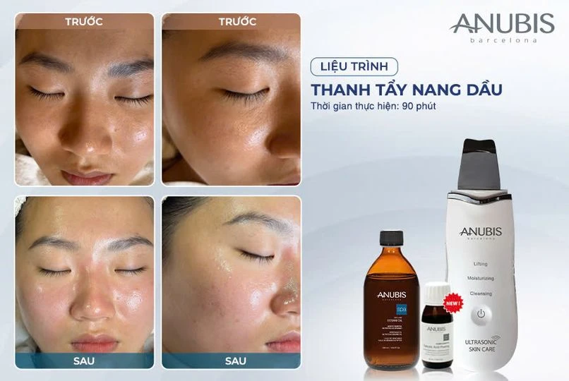 Nhả vía làn da xinh đẹp ngay sau 1 lần thanh tẩy